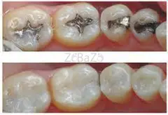 Teeth filling in Dubai AED 250  White color teeth filling cost in Dubai - 1
