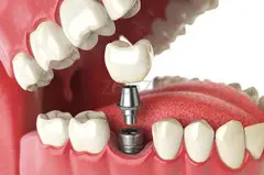 Dental Implant in Dubai - 1