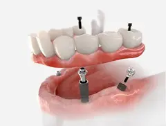 Dental implants treatment in Dubai UAE