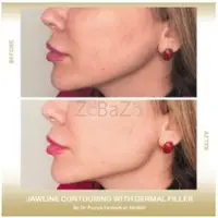 Enhance Your Facial Contours with Jawline Filler in Dubai - 1