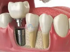 Dental implants in india - 1