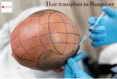 Hair Transplant in Bangalore