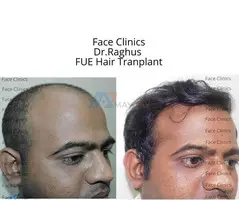 Best FUE hair transplant in Hyderabad l Faceclinics