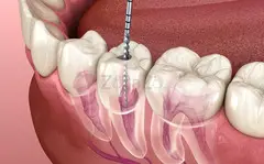 Root Canal Treatment Whitefield-Cost of Root Canal Treatment