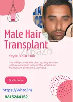 Hair transplant in Ludhiana -walia hair transplant in Ludhiana - 4