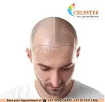 Restoring Your Crowning Glory Celestee Hair Transplant