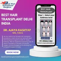 Best Hair Transplant Delhi - 1