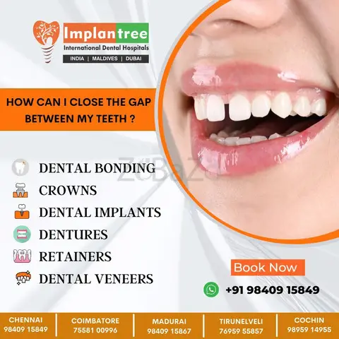 FREE Consultation for Dental Treatment | Dental Implants Chennai - 1