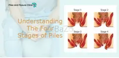 Understanding the Four Stages of Piles: A Comprehensive Guide