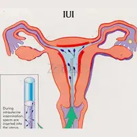 Infertility specialist in Bangalore - Best IUI centers in Bangalore - 1