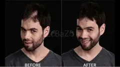 Hair Fixing in Bangalore-Hair Fixing Services-Hair Fixing Treatment-Hair Weaving Services - 1