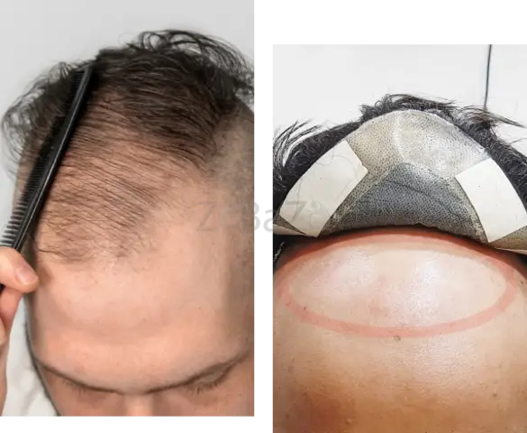 Hair Replacement in Bangalore-Hair Replacement Center - 1