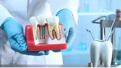 Best Dental Implants in Chennai- Akeela dental care - 1