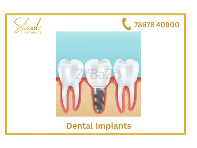 Tooth implants in coimbatore | dental implants - 1