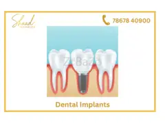 Tooth implants in coimbatore | dental implants