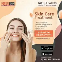 Stretch Marks  Laser  Treatment in India