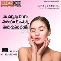 Birthmark removal treatment in india