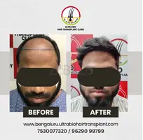 Hair transplant in Bengaluru