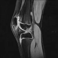MRI of Knee Joint at Marris Medical for Accurate Joint Diagnosis