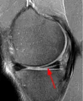 Where Can I Get an MRI of the Knee Joint Quickly?
