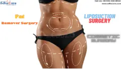 Reshaping Beauty: The Art and Science of Liposuction Surgery