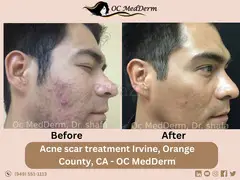 Best Acne scar treatment by Dr.Shafa in Irvine, Califonia - OC MedDerm