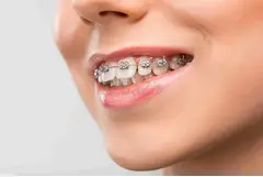 Transform Your Smile: Premier Invisalign Orthodontist in Lewisville