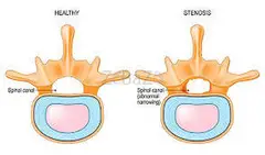 Spinal stenosis surgery San Antonio, TX