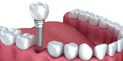 Invisalign clear aligners Duluth, GA